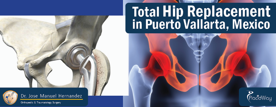Total Hip Replacement in Puerto Vallarta, Mexico
